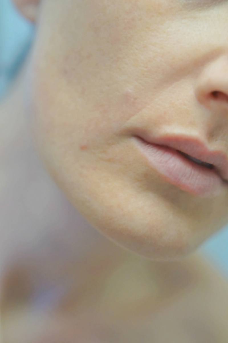 How To Get Clear Skin with The Neutrogena Light Therapy Acne Mask